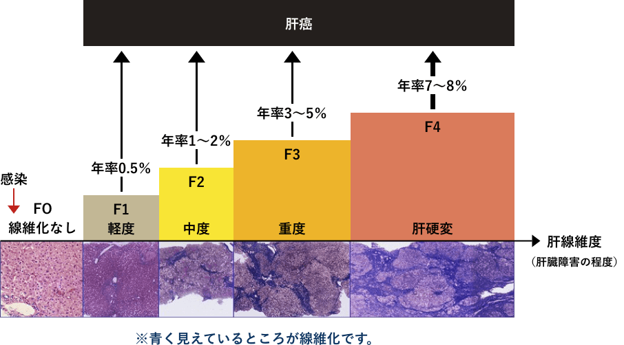 肝臓の線維化の進展と発癌率の図