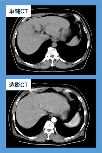 単純CT（上）と造影CT（下）の比較写真。造影CTでは、2cm以下の腫瘍が1つ抽出されています。
