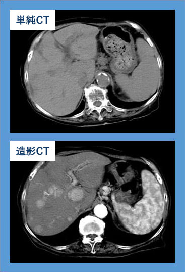 単純CT（上）と造影CT（下）の比較写真。造影CT（下）では、多発性の肝癌がはっきり抽出されています。