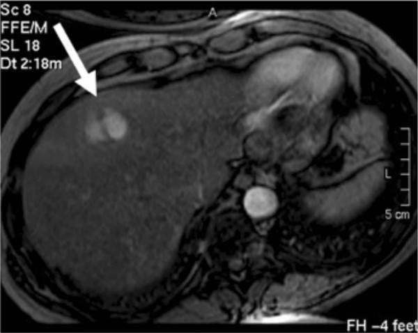 早期相の造影MRI