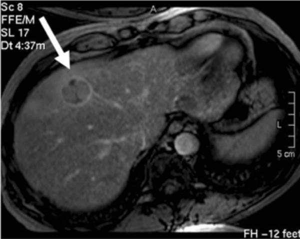 後期相の造影MRI