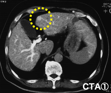 CTA1（動脈造影）の写真