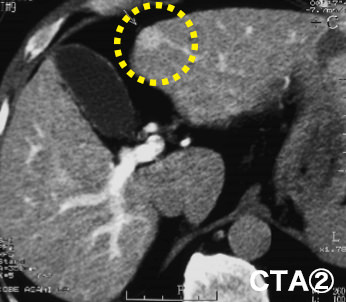 CTA2（動脈造影）の写真