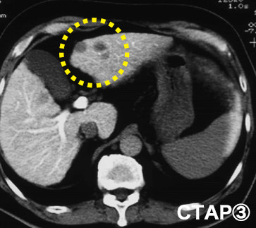 CTAP3（門脈造影）の写真