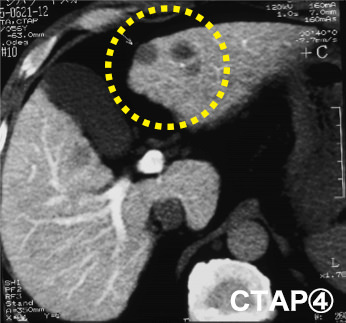 CTAP4（門脈造影）の写真