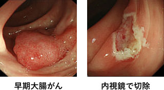 早期大腸がん（画像左）を内視鏡で切除（画像右）。