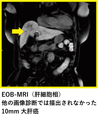 EOB-MRI（肝細胞相）他の画像診断では描出されなかった10mm大肝癌の写真