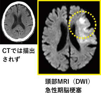 CTでは描出されなかった、頭部MRI（DWI）急性期脳梗塞の写真