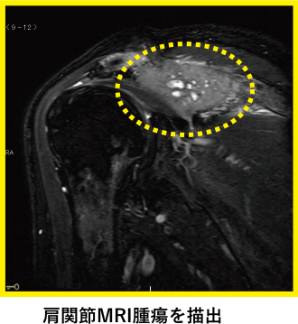 肩関節MRI腫瘍を描出