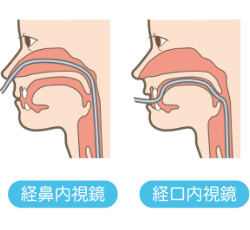 経鼻内視鏡（鼻からカメラ）のイラスト